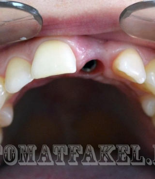 Протезирование с опорой на имплантате в области зуба 21