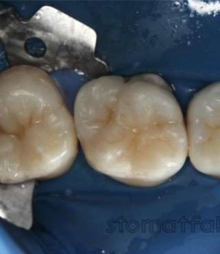 Лечение кариеса 16 и 17 зубов