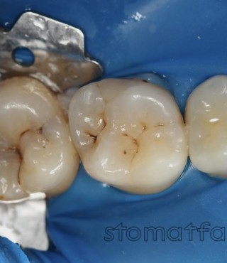 Лечение кариеса 16 и 17 зубов